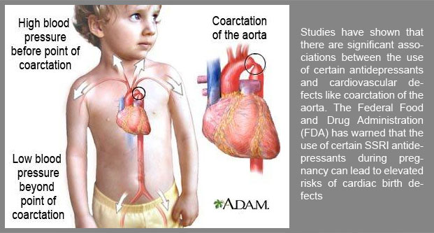 Studies have shown that there are significant associations between the use of certain antidepressants and cardiovascular defects like coarctation of the aorta.