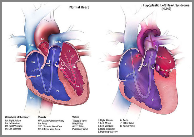 Hypoplastic left heart syndrome (HLHS) is a rare congenital heart defect that occurs when the left side of a newborn’s heart is underdeveloped.