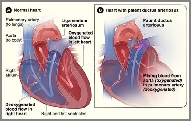 Patent ductus arteriosus (PDA) occurs when the ductus arteriosus fails to close normally soon after birth. This condition leads to abnormal blood flow through the heart and can lead to very low oxygen levels. PDA is a very serious birth defect that can lead to congenital heart failure.