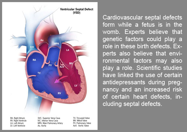 Scientific studies have linked the use of certain antidepressants during pregnancy and an increased risk of certain heart defects, including septal defects.