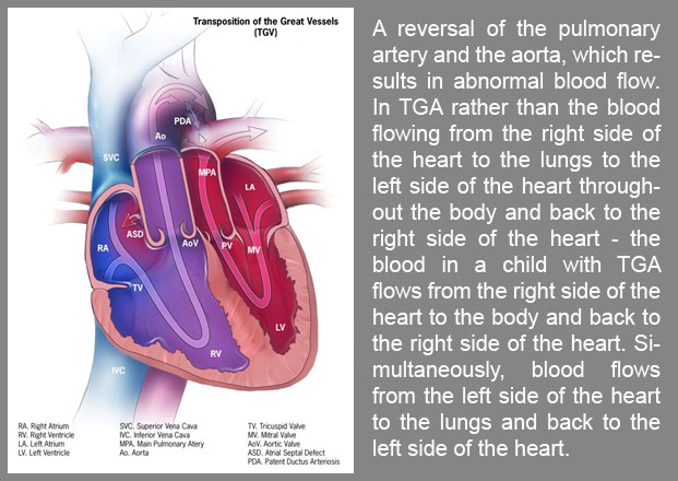Transposition of the great arteries, also known as transposition of the great vessels, is a rare congenital heart defect where the aorta and the pulmonary artery are switched or reversed (transposed). 