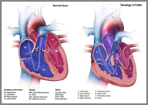 Research has shown a link between the use of certain antidepressants during pregnancy and a higher incidence of certain birth defects, including heart defects like tetralogy of Fallot.